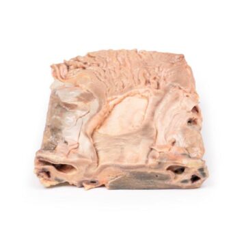Chronic Gastric Ulcer