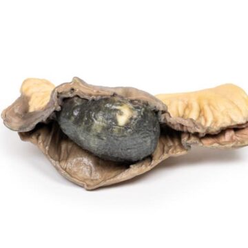 Gall Stone Ileus