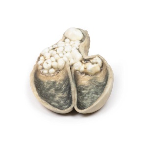 Cholecystitis and Cholelithiasis