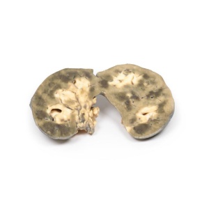 Horseshoe Kidney