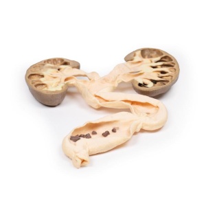 Hydronephrosis Hydroureter
