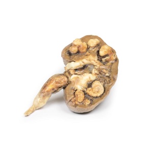 Multiple Renal Calculi