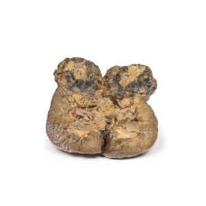 Renal Cell Carcinoma