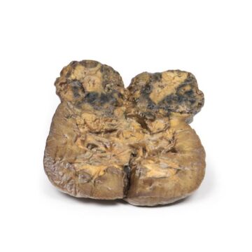 Renal Cell Carcinoma