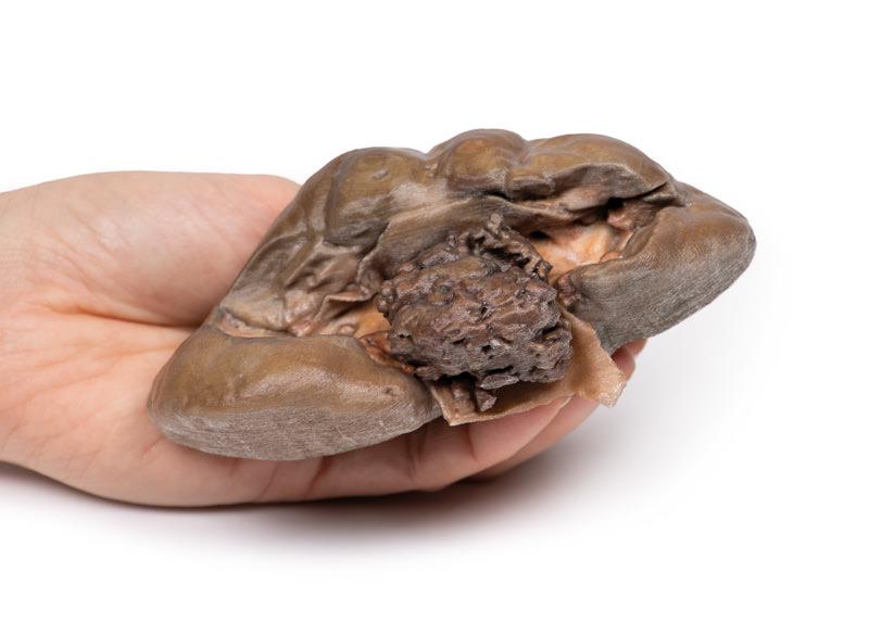 Papillary Transitional Cell Carcinoma of the Renal Pelvis - 5
