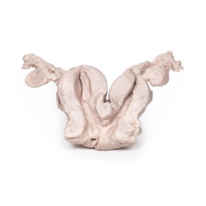 Uterus Bicornuate Unicollis