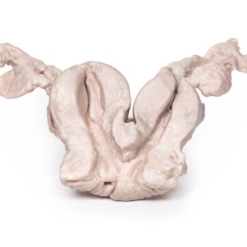 Uterus Bicornuate Unicollis