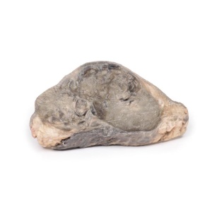 Carcinoma of Breast