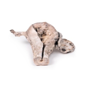 Endometrial Carcinoma