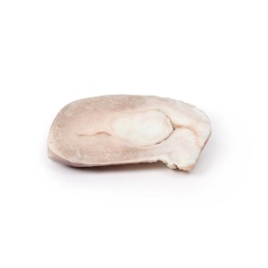 Uterine Leiomyoma