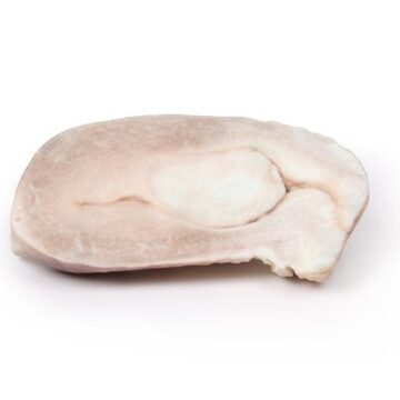 Uterine Leiomyoma