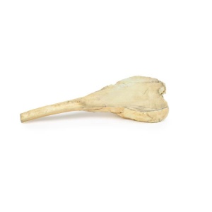 Osteosarcoma of femur