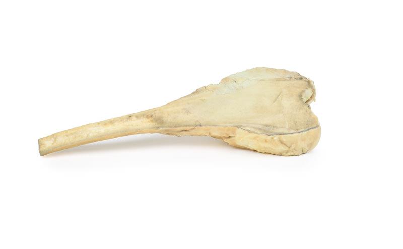 Osteosarcoma of femur