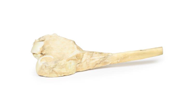 Osteosarcoma of femur - 2