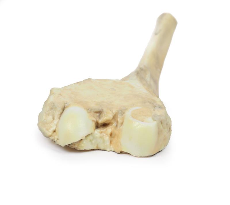 Osteosarcoma of femur - 3