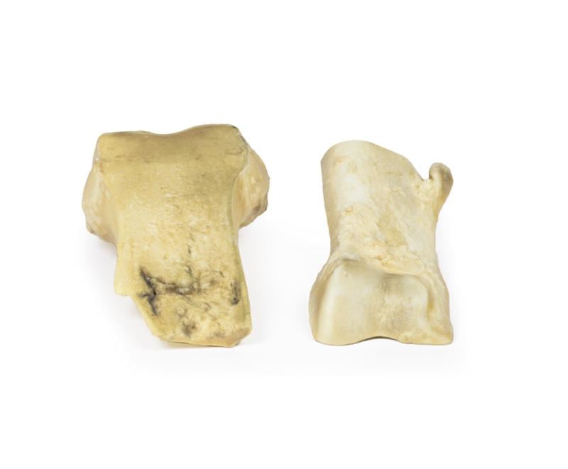 Osteochondroma - 2