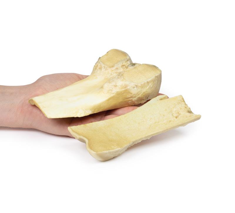 Osteochondroma - 4