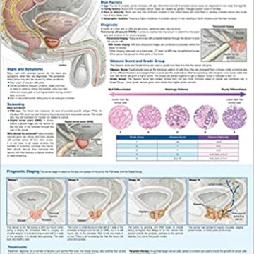 Understanding Prostate Cancer Anatomical Chart - Soft Laminate