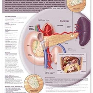 Understanding Pancreatic Cancer Anatomical Chart - Soft Laminate