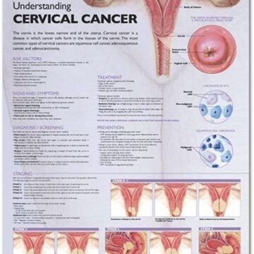 Understanding Cervical Cancer Anatomical Chart - Soft Laminate