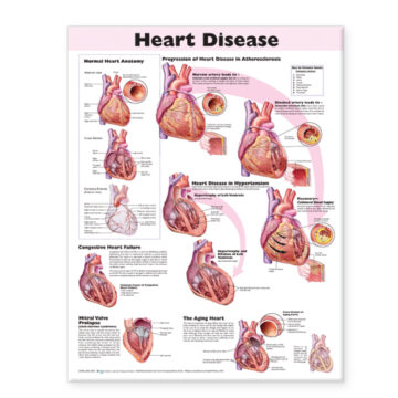 Heart Disease Anatomical Chart - Soft Laminate