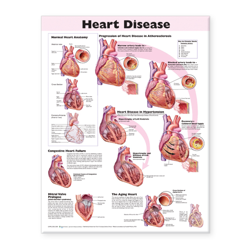 Heart Disease Anatomical Chart - Soft Laminate