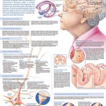 Understanding Alzheimer's Disease Anatomical Chart - Soft Laminate