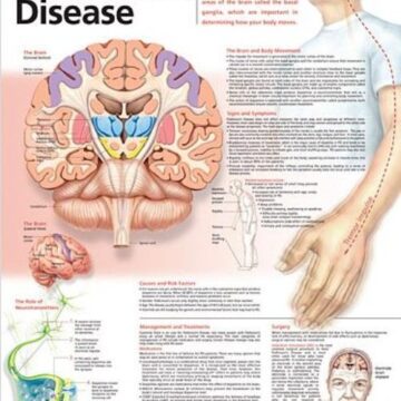 Understanding Parkinson's Disease Anatomical Chart - Soft Laminate
