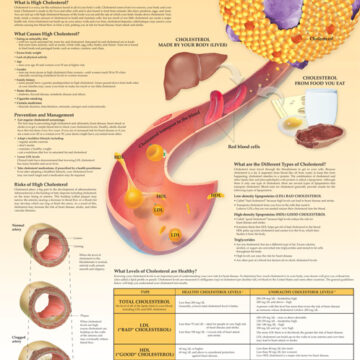 Understanding High Cholesterol - Soft Laminate