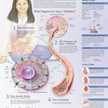 Understanding Type 1 Diabetes Anatomical Chart - Soft Laminate