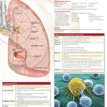 Non-Small Cell Lung Cancer - Soft Laminate