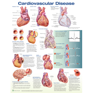 Cardiovascular Disease – Soft Laminate