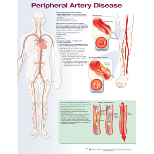 Peripheral Artery Disease – Soft Laminate