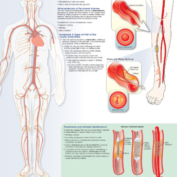 Peripheral Artery Disease - Soft Laminate