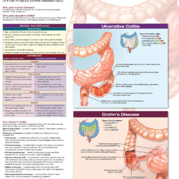 Ulcerative Colitis & Crohn's Disease - Soft Laminate
