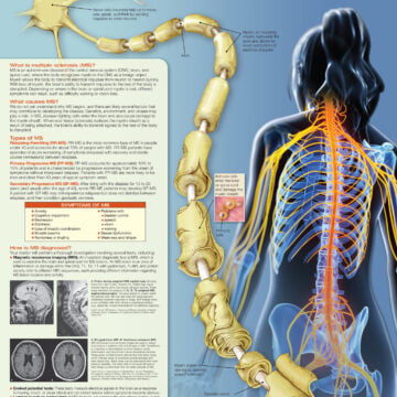 Understanding Multiple Sclerosis - Soft Laminate