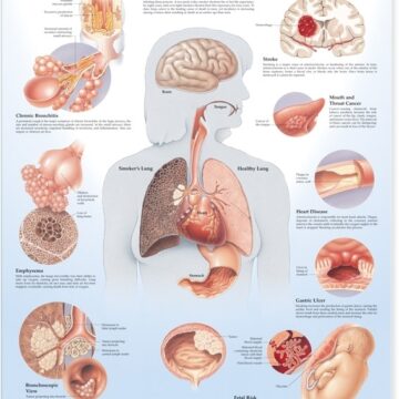 Dangers of Smoking Anatomical Chart - Soft Laminate