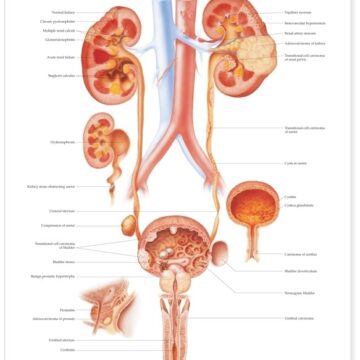 Diseases of the Urinary Tract Anatomical Chart - Soft Laminate