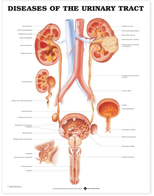 Diseases of the Urinary Tract Anatomical Chart - Soft Laminate