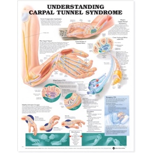 Understanding Carpal Tunnel Syndrome Anatomical Chart – Soft Laminate