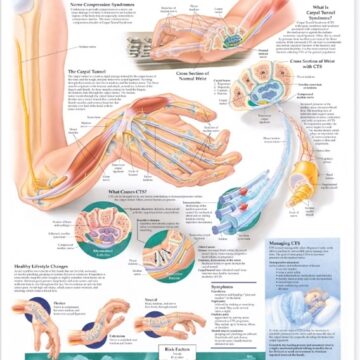 Understanding Carpal Tunnel Syndrome Anatomical Chart - Soft Laminate