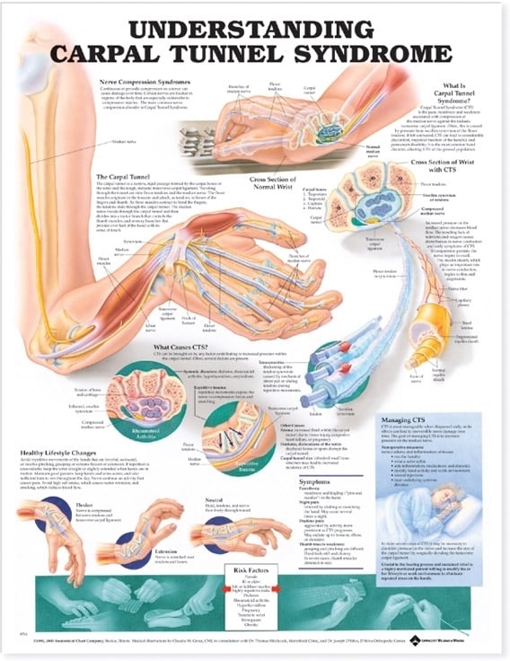 Understanding Carpal Tunnel Syndrome Anatomical Chart - Soft Laminate