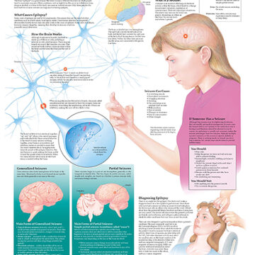 Understanding Epilepsy Anatomical Chart - Soft Laminate