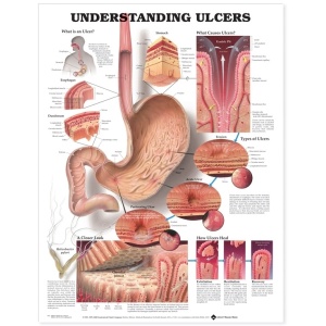 Understanding Ulcers Anatomical Chart – Soft Laminate