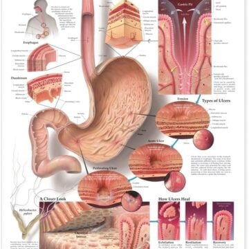 Understanding Ulcers Anatomical Chart - Soft Laminate
