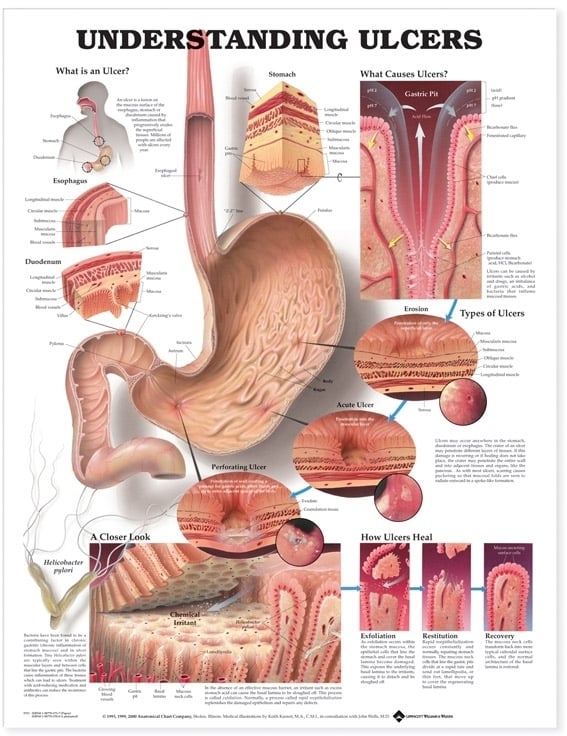 Understanding Ulcers Anatomical Chart - Soft Laminate