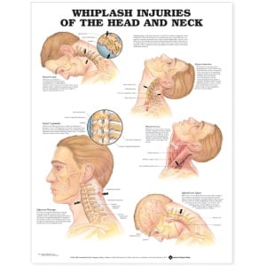 Whiplash Injuries of the Head and Neck Anatomical Chart – Soft Laminate