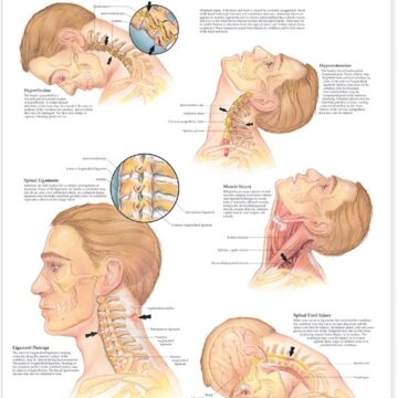 Whiplash Injuries of the Head and Neck Anatomical Chart - Soft Laminate