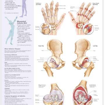 Understanding Arthritis Anatomical Chart - Soft Laminate