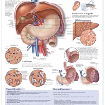 Understanding Hepatitis Anatomical Chart - Soft Laminate